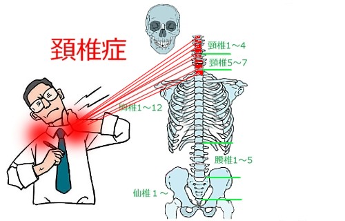 頚椎症