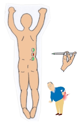 腰痛鍼灸6