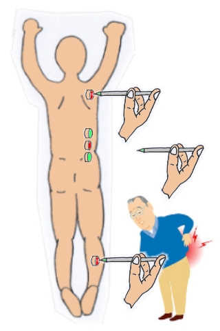 腰痛鍼灸12