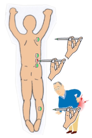 腰痛鍼灸14