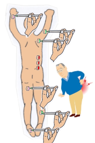 腰痛鍼灸18