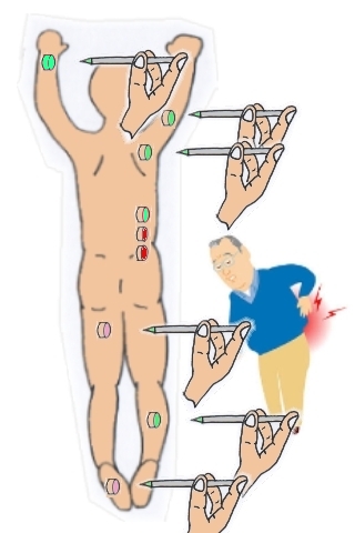 腰痛鍼灸19